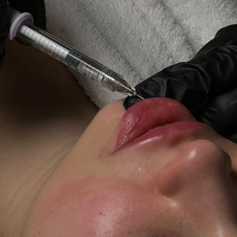 Close-up of a lip being treated with a medical device