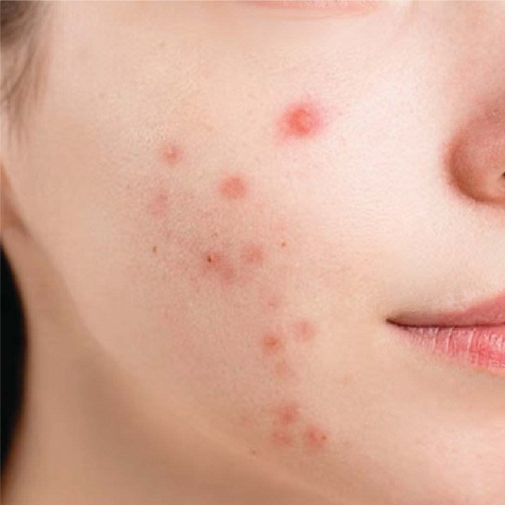 Concern -> Acne