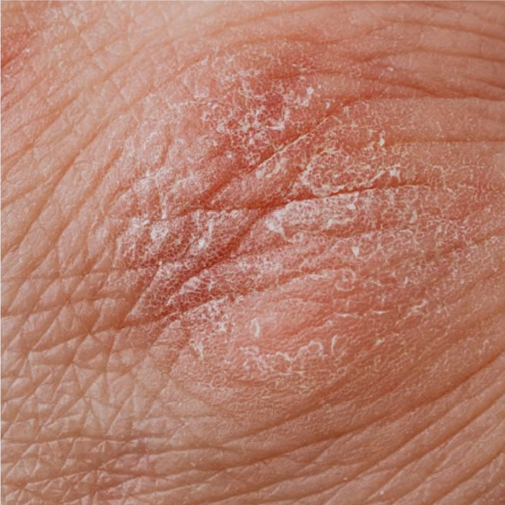 Concern -> Eczema