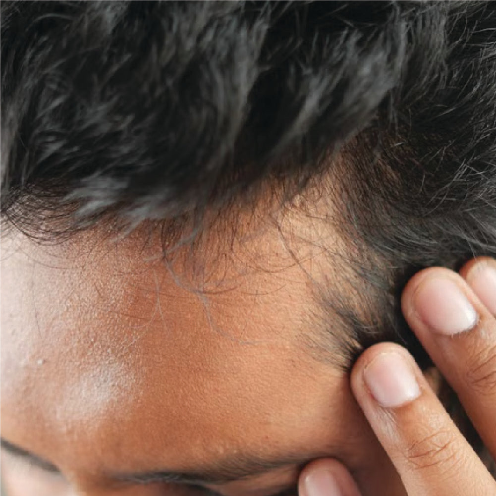 Concern -> Hair Loss