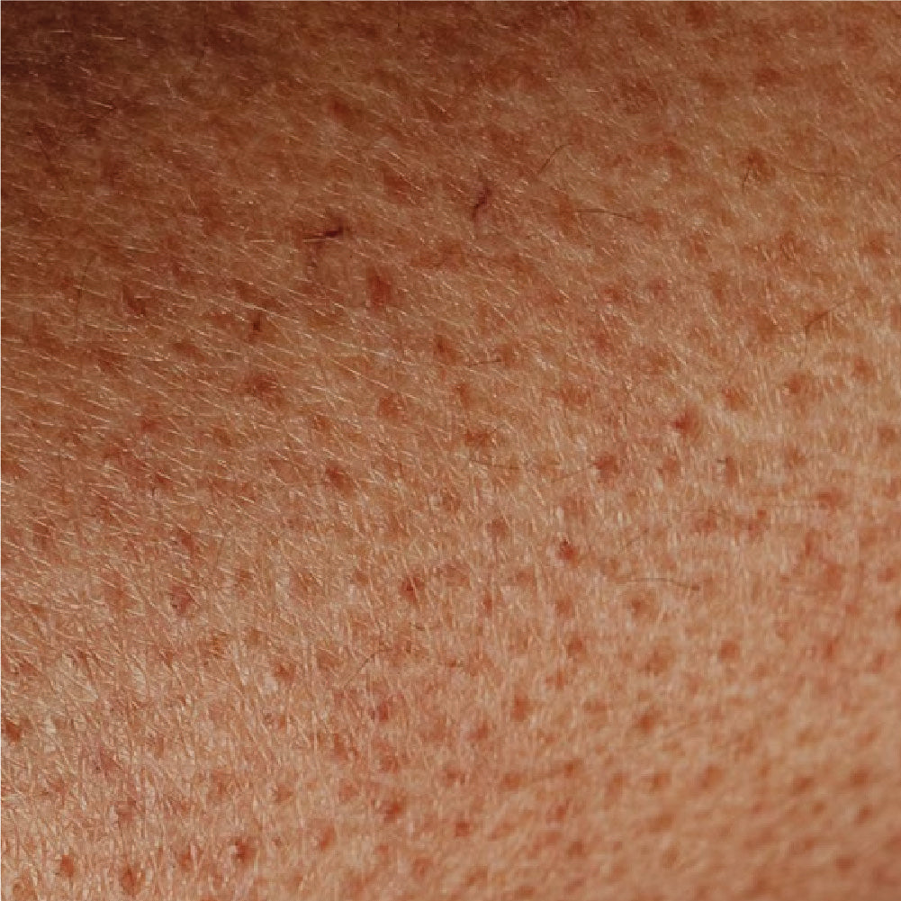 Concern -> Keratosis Pilaris