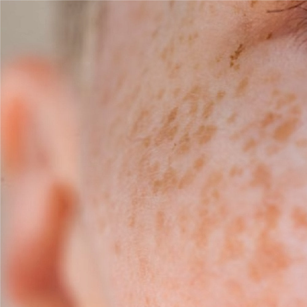 Concern -> Melasma/Hyperpigmentation