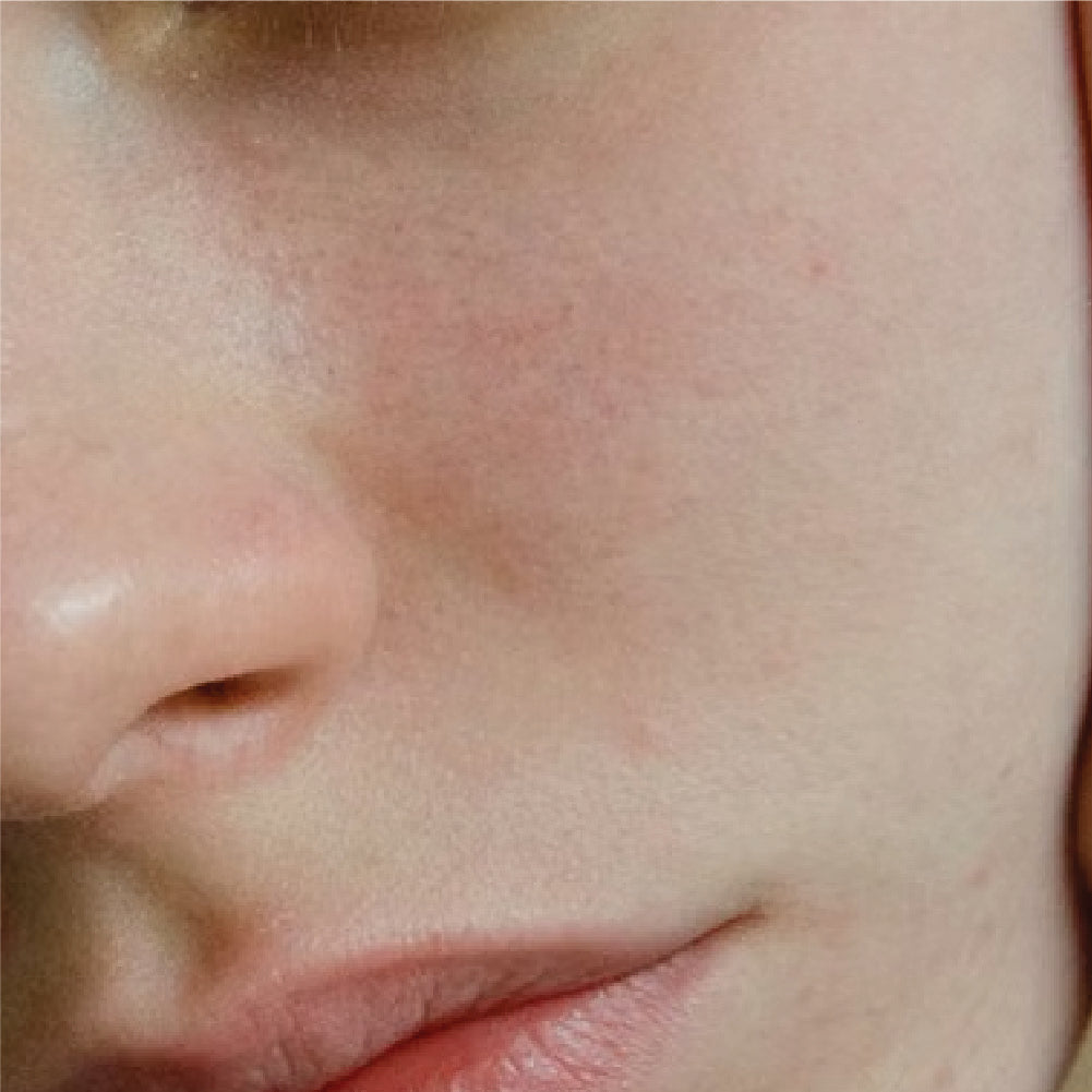 Concern -> Rosacea